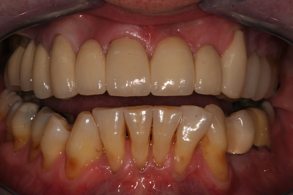 after  dental bridge treatment