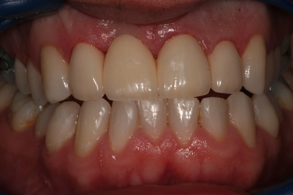after  dental bridge treatment