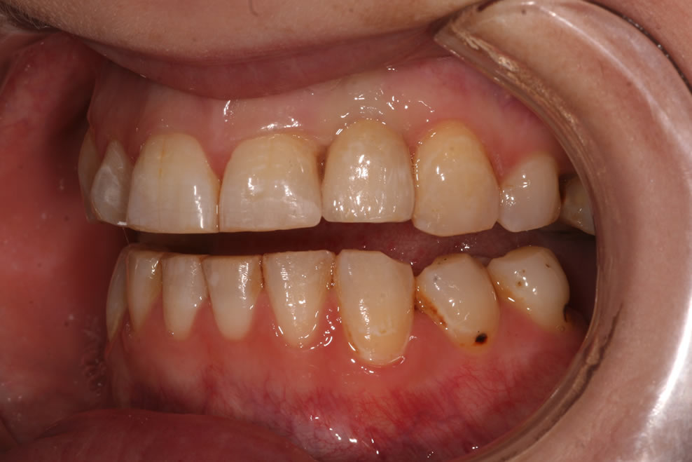 dental implants treamtment process
