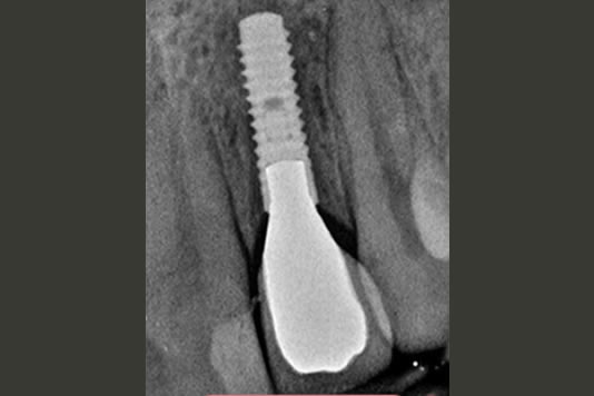 dental implants treamtment process