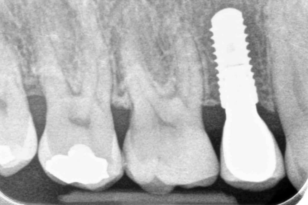 dental implants treamtment process