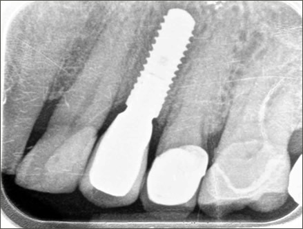 dental implants treamtment process