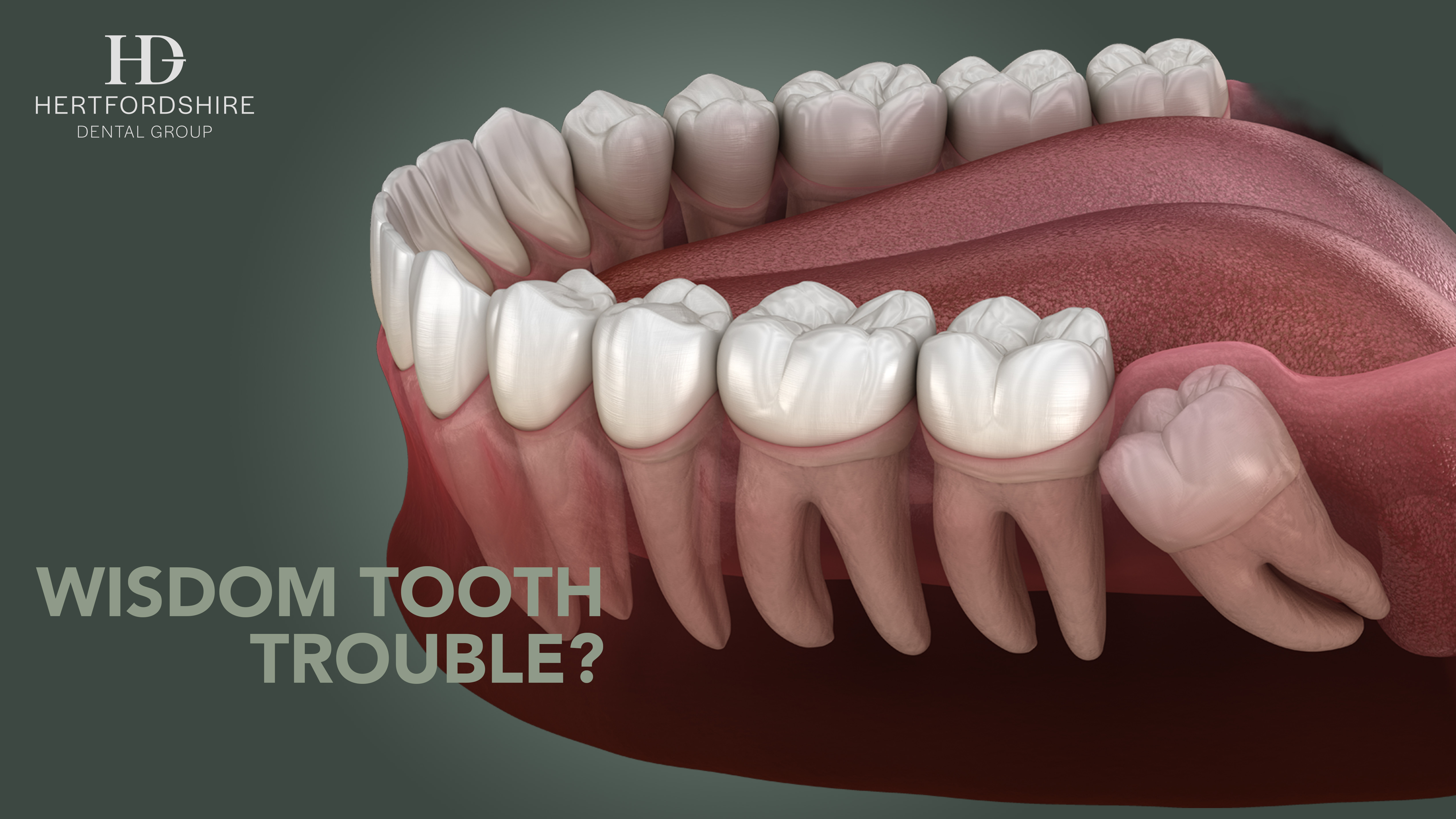 Words of Wisdom: Your complete guide to Tooth Extraction in Hertford and Ware