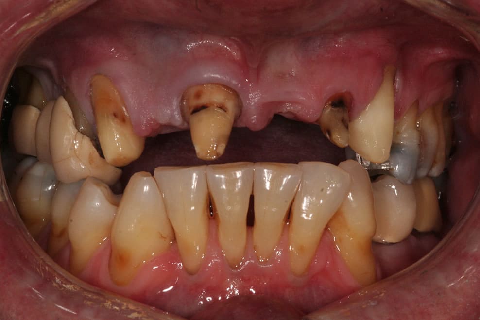 before dental bridge treatment