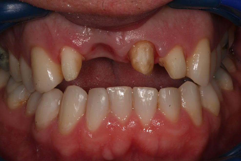 before dental bridge treatment