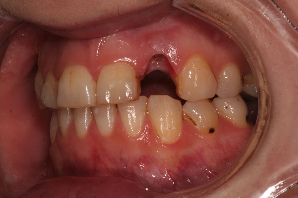 dental implants treamtment process
