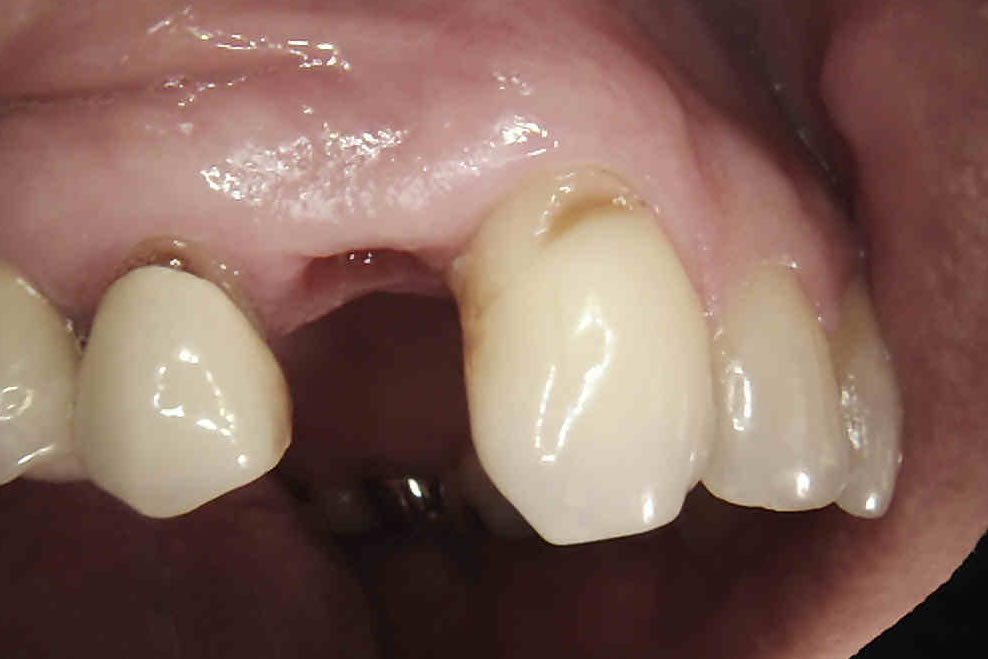 dental implants treamtment process