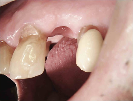 dental implants treamtment process